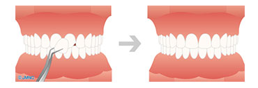 すきっ歯や歯の形を改善