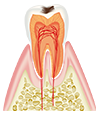 エナメル質に到達した虫歯